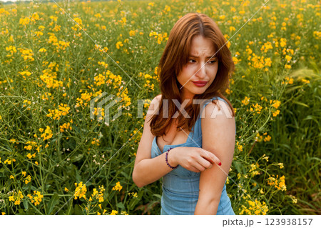 The girl has an allergic reaction to rapeseed pollen 123938157