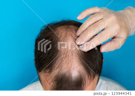 Baldness, a man is examined by a doctor in gloves on a blue background close-up. Baldness, a man is examined by a doctor in gloves on a blue background close-up. 123944341