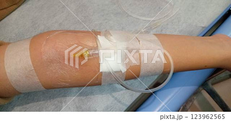 高熱が出た子供に点滴 123962565