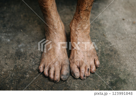 Close up of male wrinkled hands, old man is wearing  skin disease and anxiety Copy space. 123991848