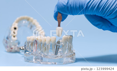 Close-up of a gloved hand using a dental shade guide to match the color of a tooth implant on a model jaw. Close-up of a gloved hand using a dental shade guide to match the color of a tooth implant on a model jaw. 123999424
