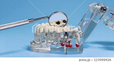 dental model with decayed teeth examined using a dental mirror, illustrating cavities and oral health issues in dentistry dental model with decayed teeth examined using a dental mirror, illustrating cavities and oral health issues in dentistry 123999426