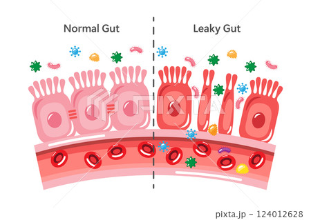 Leaky gut syndrome and healthy gut . Cute medical cartoon . Vector . 124012628