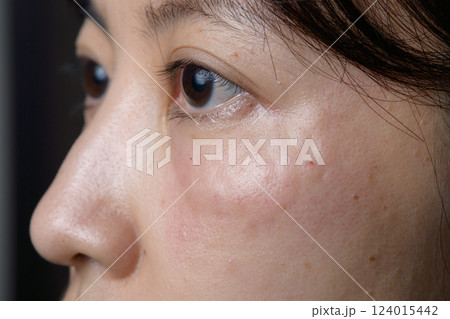 Close up of Asian woman face showing skin texture and swelling under eye Close up of Asian woman face showing skin texture and swelling under eye 124015442