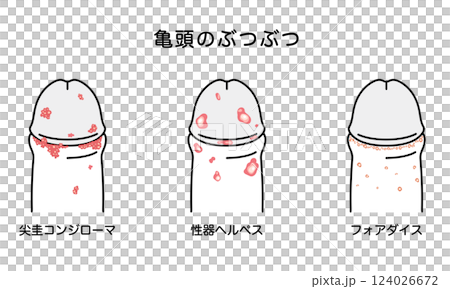 Bumps on male genitals - types of sexually transmitted diseases Bumps on male genitals - types of sexually transmitted diseases 124026672