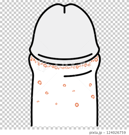 Fordyce spots: bumps on the male genitals Fordyce spots: bumps on the male genitals 124026759