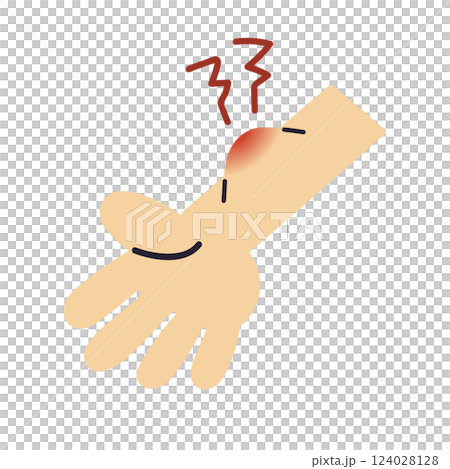 紅腫的手臂、昆蟲叮咬、瘀傷/向量手繪插圖 紅腫的手臂、昆蟲叮咬、瘀傷/向量手繪插圖 124028128