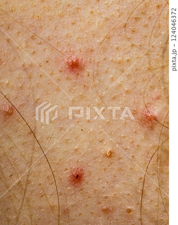 Closeup skin with acne moles and red spots. 124046372