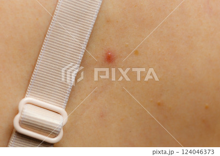 Closeup skin with acne moles and red spots. 124046373