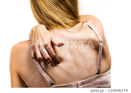 Woman with skin problem acne on back 124046374