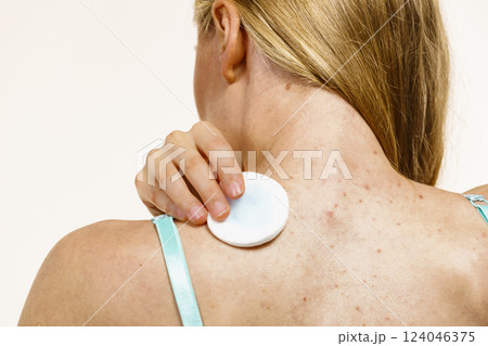 Woman acne on back cleaning skin with tonic 124046375