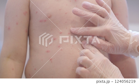 A child with a skin condition chickenpox enjoys their time at the pool, engaging in fun activities 124056219