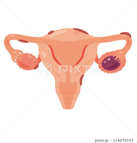 子宮内膜症になった子宮のイラスト2 124070555