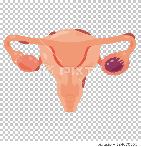 子宮内膜症になった子宮のイラスト2 124070555