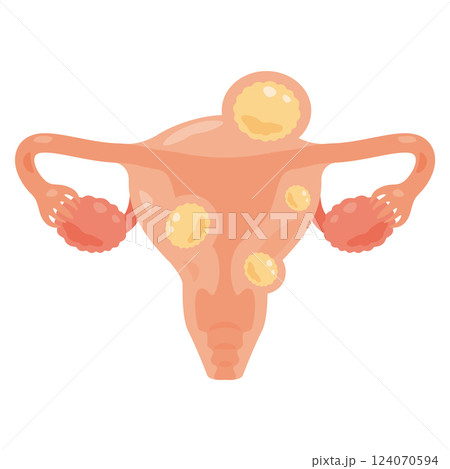 子宮筋腫ができた子宮のイラスト2 124070594