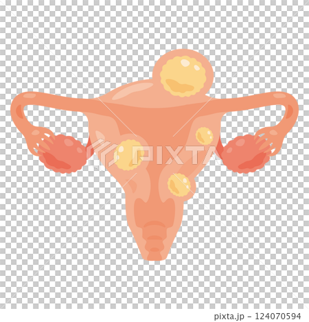 子宮筋腫ができた子宮のイラスト2 124070594