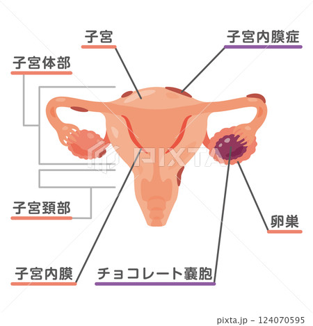 子宮内膜症になった子宮のイラスト1 124070595