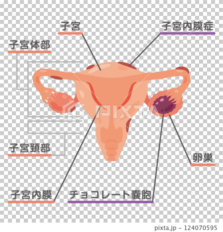 子宮内膜症になった子宮のイラスト1 124070595