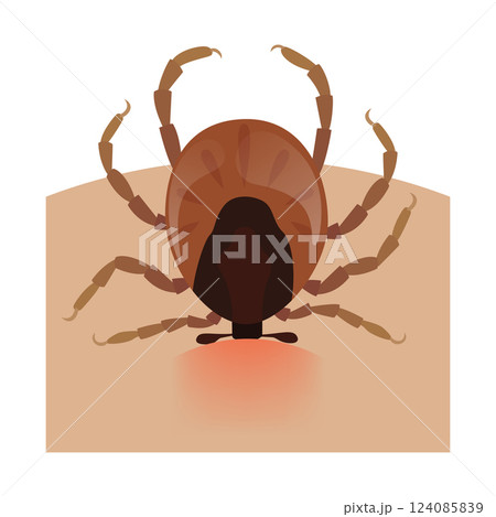 Encephalitis tick biting human skin causing lyme disease Encephalitis tick biting human skin causing lyme disease 124085839