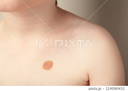 Big mole. Birthmark on body of a child. Big mole. Birthmark on body of a child. 124090452