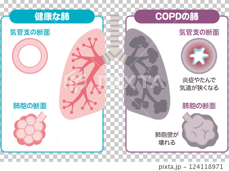 健康和慢性阻塞性肺病 124118971