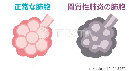 正常な肺胞と間質性肺炎の肺胞 124118972