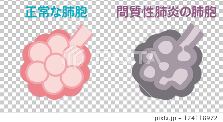 正常な肺胞と間質性肺炎の肺胞 124118972