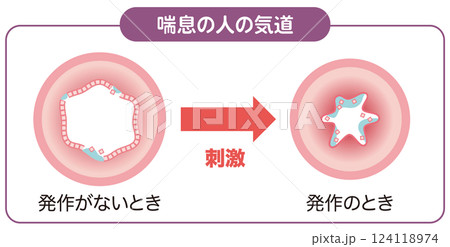 喘息の人の気道 124118974