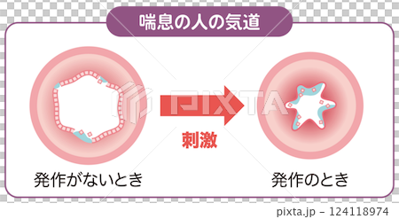喘息の人の気道 124118974