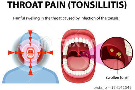 Understanding Throat Pain and Tonsillitis 124141545