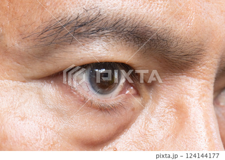 Senior man eye strain after for long stretches at computer or digital screens. 124144177