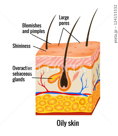 Oily skin anatomy. Human body skin vector illustration with parts vein artery hair sweat gland epidermis dermis and hypodermis. Human Cross-section of the skin layers structure 124153332