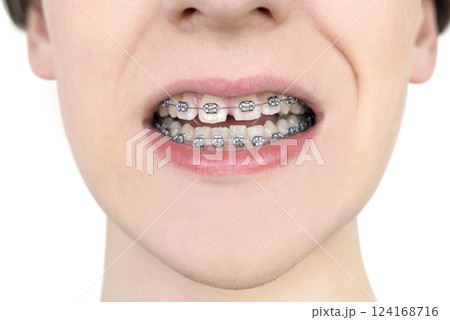 Crooked growing teeth after visiting the dentist and installing braces 124168716