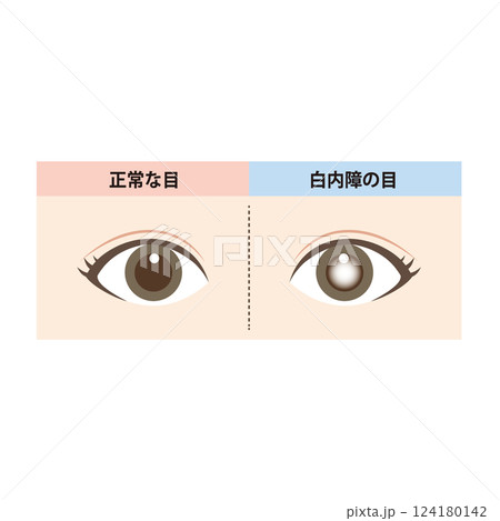 正常な目と白内障の目の比較のイラスト 正常な目と白内障の目の比較のイラスト 124180142