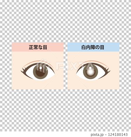 Illustration of a comparison between a normal eye and an eye with cataracts Illustration of a comparison between a normal eye and an eye with cataracts 124180143
