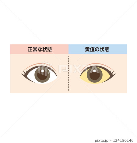 正常な目と白目に黄疸が出ている目の比較イラスト 124180146
