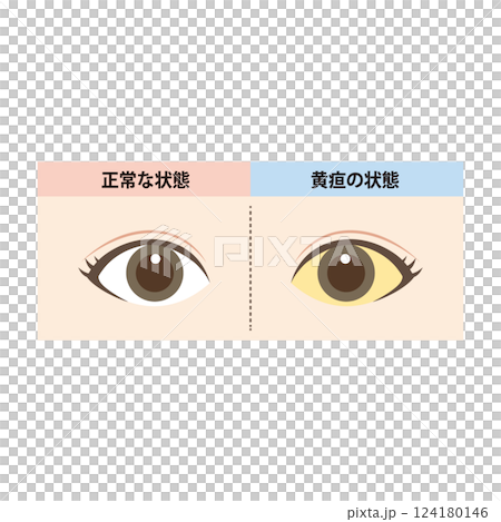 正常眼睛與眼白黃疸眼睛的比較圖 正常眼睛與眼白黃疸眼睛的比較圖 124180146