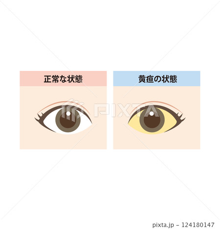 正常な目と白目に黄疸が出ている目の比較イラスト 124180147