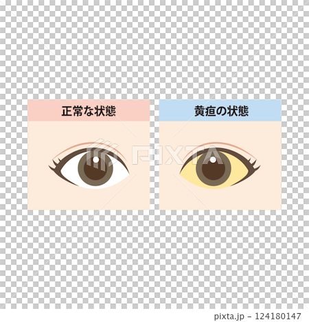 正常な目と白目に黄疸が出ている目の比較イラスト 124180147