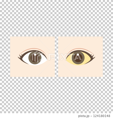 正常な目と白目に黄疸が出ている目の比較イラスト 124180148
