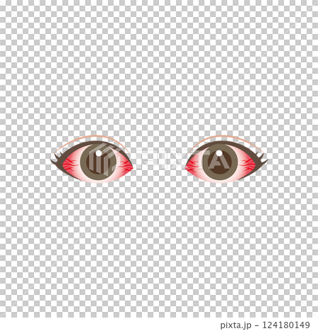 結膜炎などで激しく充血した両目 124180149