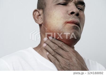The man has facial swelling due to an allergic reaction to triggers such as insect bites stings. 124188892