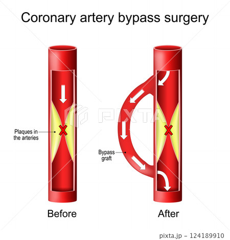 Coronary artery bypass graft. Heart surgery Coronary artery bypass graft. Heart surgery 124189910