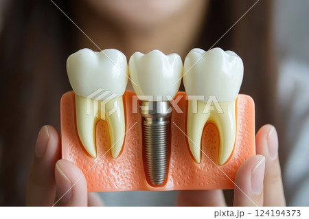A dentist holding a a dental implant in her hand. 124194373