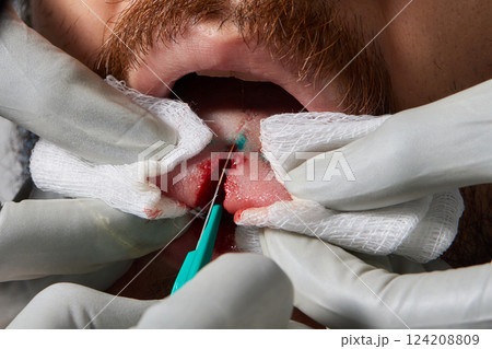 tongue splitting. cutting the tongue, one type of modification of the human body. surgery concept. 124208809