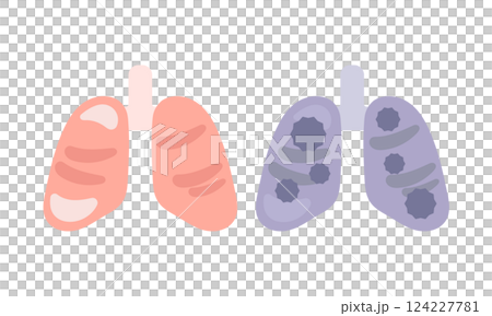 綺麗な肺　汚れた肺（肺ガン）　イラスト 124227781