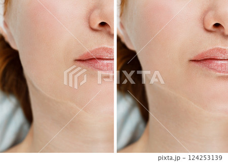 Female double chin before and after correction. Result of procedure in the clinic of aesthetic medicine. Female double chin before and after correction. Result of procedure in the clinic of aesthetic medicine. 124253139