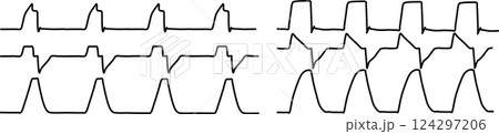 人工呼吸器のグラフィック波形の素材イラスト 124297206