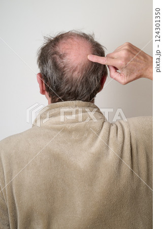 Human hair loss solution concept Human hair loss solution concept 124301350
