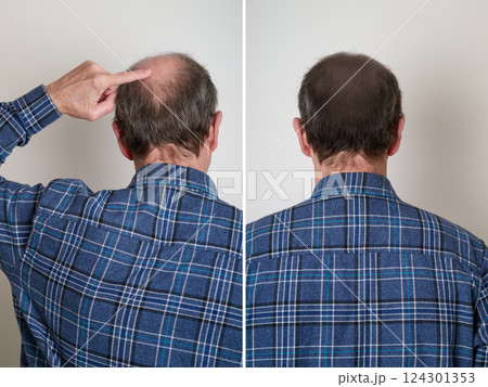 Human hair loss solution concept 124301353